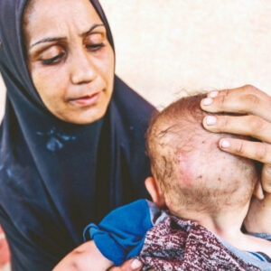 acliktan bebeklerin derisi curuyor ttA8YKif